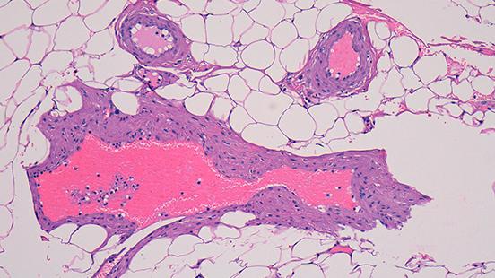 Patologia Molecular Translacional a Vall d'Hebron Institut de Recerca